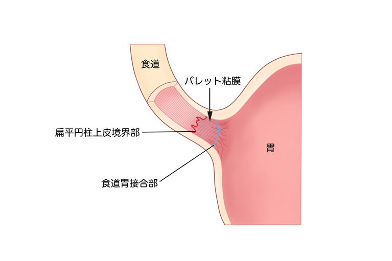 バレット食道と食道がんの関係