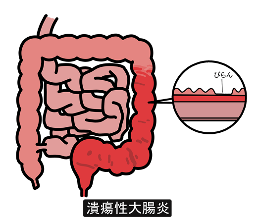潰瘍性大腸炎（UC：Ulcerative Colitis）