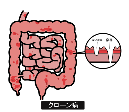 クローン病（CD：Crohn’s Disease）