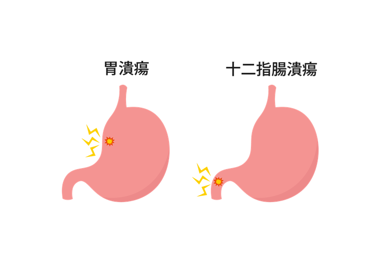 粘膜がえぐれる胃潰瘍・十二指腸潰瘍