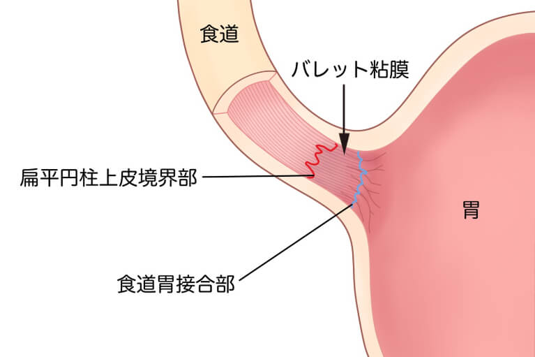 「バレット食道」は“がんの前兆”？